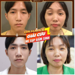 CHÀO THÁNG 6 - DR.HẢI LÊ TRỢ GIÁ MÙA COVID 2O SUẤT CHỈNH HÌNH MÍ SỤP BẨM SINH CHỈ TỪ 11tr8 đến 24tr9