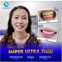 CÔNG NGHỆ SUPER ULTRA THIN – KHÔNG ĐAU, KHÔNG Ê BUỐT, KHÔNG BIẾN CHỨNG