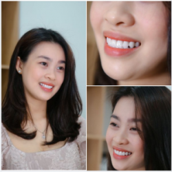 HÀM RĂNG ĐẸP THẾ NÀY ĐỦ THUYẾT PHỤC BẠN ĐẾN NHA KHOA GIA ĐÌNH CHƯA