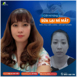 KHẮC PHỤC BIẾN CHỨNG – MẮT ĐẸP TỰ NHIÊN