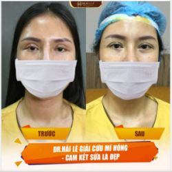 Mắt lỗi hỏng: Đã làm mí 2 lần, Size mí quá to, hốc mắt sâu khuyết mỡ, mô xơ sẹo cũ co dính đính sâu, sụp mi, mắt buồn lờ đờ