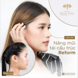 Nâng mũi cấu trúc Reform cân chỉnh dáng mũi hoàn hảo