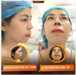 REVIEW NÂNG MŨI CƠ SỞ DR.HẢI LÊ HCM ĐỘNG LỰC NÂNG MŨI LÀ ĐÂY CHỨ ĐÂU!