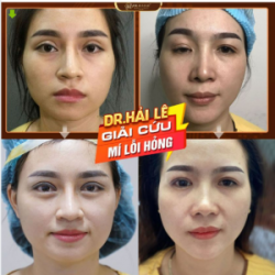 SỬA MÍ DEEP TECH20 - SỬA LẠI ĐÔI MẮT “ĐỔI LẤY NỤ CƯỜI”.!!