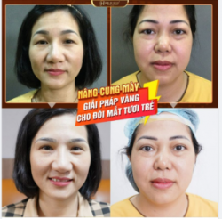 SỤP MÍ TUỔI TRUNG NIÊN GIẢI PHÁP NÀO HIỆU QUẢ NHẤT HIỆN NAY