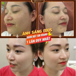 Tại sao da dẻ của NGƯỜI TA đẹp từ trong ra ngoài Còn của TÔI tàn nhang, nám mảng, sạm từ trong ra Da