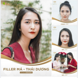 Trả lại nét xuân thì- ĐẸP TỰ NHIÊN nhưng không tự nhiên mà đẹp. Bí kíp chính là Filler đầy hóp má, thái dương tại Tấm.