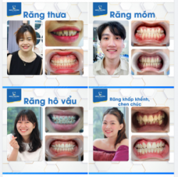 Muôn hình vạn trạng của răng trước và sau khi niềng răng
