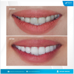 Thay răng sứ cũ “đổi” diện mạo mới cho răng