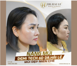 Nâng mũi Demi Tech 6D Dr.Hải Lê, mũi đẹp miễn chê