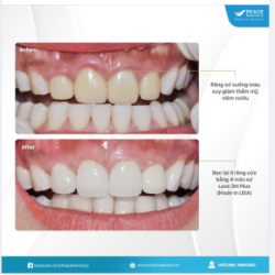 Ca lâm sàng thẩm mỹ răng sứ giải pháp lí tưởng cải thiện nụ cười