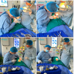Trồng implant răng R21 R22 bệnh nhân Lê Vũ Quân 46 tuổi.