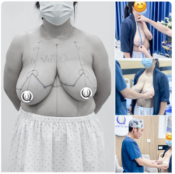 Ca ngực "SIÊU TO KHỔNG LỒ" nặng đến 4kg đã tìm tới bác sĩ Vũ Quang với mong muốn giảm kích cỡ V1.