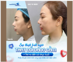 Thực tế, tình trạng cằm lẹm, cằm ngắn không chỉ khiến khuôn mặt mất đi sự cân đối, tạo cảm giác miệng bị hô, mà còn làm diện mạo cộng thêm vài tuổi.