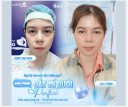 NGỦ ĐỦ MÀ MẮT VẪN THIẾU NGỦ? GIẢI PHÁP CẮT MÍ DƯỚI PERFECT