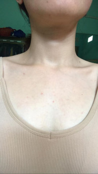 CÁCH NGUYÊN TRỊ MỤN Ở NGỰC VÀ LƯNG