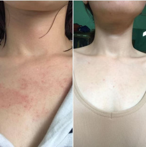 CÁCH MÌNH TRỊ BỚT MỤN Ở NGỰC VÀ LƯNG