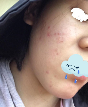 Ăn gì, uống gì, trị mụn ở đâu?
