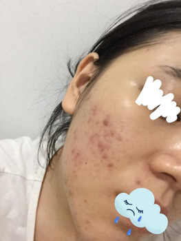 Ăn gì, uống gì, trị mụn ở đâu?