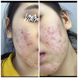Ăn gì, uống gì, trị mụn ở đâu?