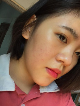 Ăn gì, uống gì, trị mụn ở đâu?