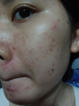 Giới thiệu sản phẩm trị mụn