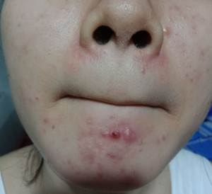 Giới thiệu sản phẩm trị mụn
