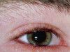 Chắp mắt là bệnh gì? Có giống lẹo mắt không?