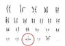 Karyotyping – Nhiễm sắc thể đồ - Bệnh viện Từ Dũ