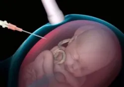 Những điều cần biết về chọc ối và sinh thiết gai nhau - Bệnh viện Từ Dũ