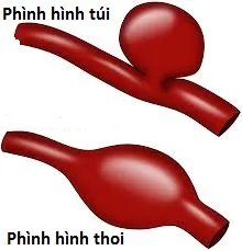 Những điều cần biết về phình động mạch não - Bệnh viện Việt Đức