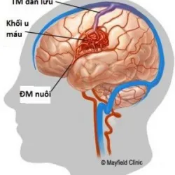 “Chuẩn vàng” để chẩn đoán u máu trong não - Bệnh viện Việt Đức