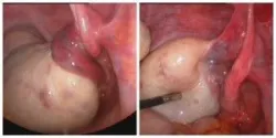 U buồng trứng xoắn - Bệnh viện Từ Dũ