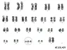 Hội chứng Down - Bệnh viện Từ Dũ