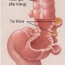 Bệnh lý túi thừa đại tràng – Phát hiện sớm để phòng những biến chứng nguy hiểm - Bệnh viện Việt Đức