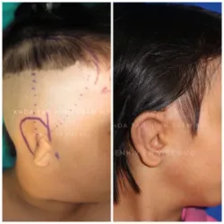 Bệnh  viện Việt Đức triển khai thành công kỹ thuật tạo hình tai sớm cho trẻ chỉ mới 4 – 5 tuổi - Bệnh viện Việt Đức