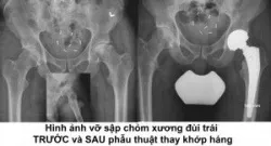 Hoại tử chỏm xương đùi do thiếu máu nuôi - Bệnh viện Việt Đức
