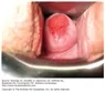 Pap' s smear bất thường - Bệnh viện Từ Dũ