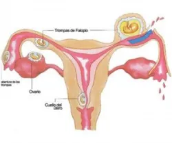 Thai ngoài tử cung: điều cơ bản cần biết - Bệnh viện Từ Dũ