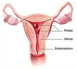 Polyp lòng tử cung là gì? Nguyên nhân, triệu chứng và điều trị - Bệnh viện Từ Dũ
