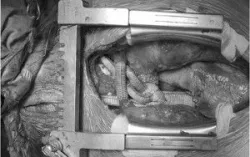 8 giờ phẫu thuật mang sự sống cho Bệnh nhân bị lóc tách động mạch chủ, nhiều biến chứng nguy kịch - Bệnh viện Việt Đức