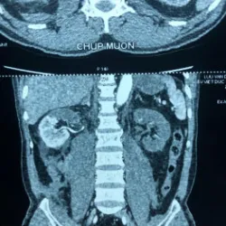 Kỳ tích ghép thận tự thân cứu quả thận đã thiếu máu đến 24 giờ - Bệnh viện Việt Đức