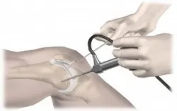 Nội soi khớp gối và những điều cần biết - Bệnh viện Việt Đức