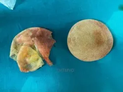 Người phụ nữ vỡ túi ngực không hay biết - Bệnh viện Việt Đức