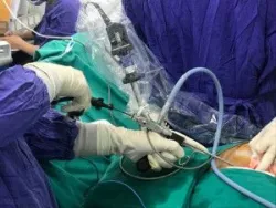 Điều trị viêm rò nang lông vùng cùng cụt bằng nội soi: Người bệnh có thể ra viện trong ngày- Bệnh viện Việt Đức