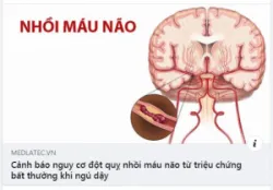 ​​​​​​​3 DẤU HIỆU BẤT THƯỜNG KHI THỨC DẬY VÀO BUỔI SÁNG CẢNH BÁO NHỒI MÁU NÃO