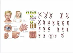 3 PHƯƠNG PHÁP XÉT NGHIỆM SÀNG LỌC HỘI CHỨNG DOWN, MẸ BẦU NÊN BIẾT