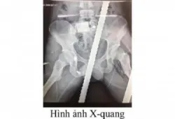 Cứu sống thanh niên bị 2 thanh sắt đâm xuyên tầng sinh môn, bụng, ngực, đùi - Bệnh viện Việt Đức