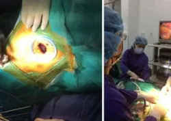 Lần đầu tiên tại Việt Nam phẫu thuật cắt phổi không cần thở máy hỗ trợ - Bệnh viện Việt Đức
