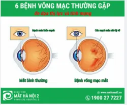 6 bệnh võng mạc thường gặp nhất hiện nay